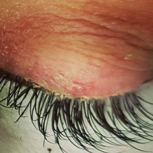 Blepharitis